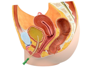 URINE CATHETER INSERTION AT HOME